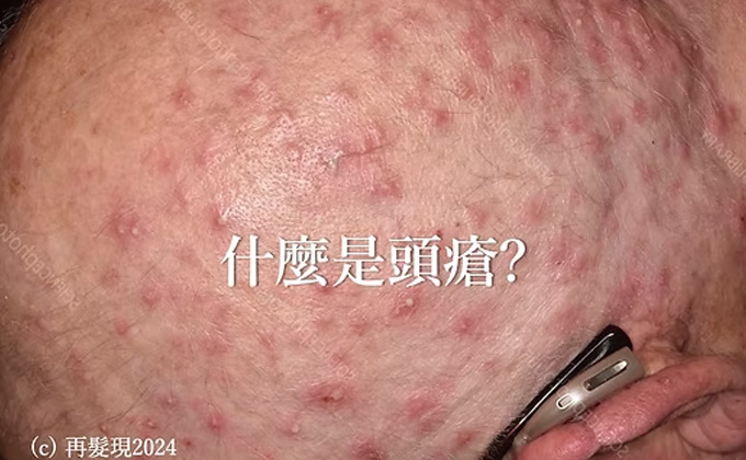 什麼是頭瘡?