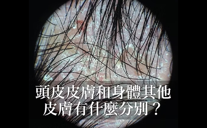 頭皮皮膚和身體其他皮膚有什麼分別？