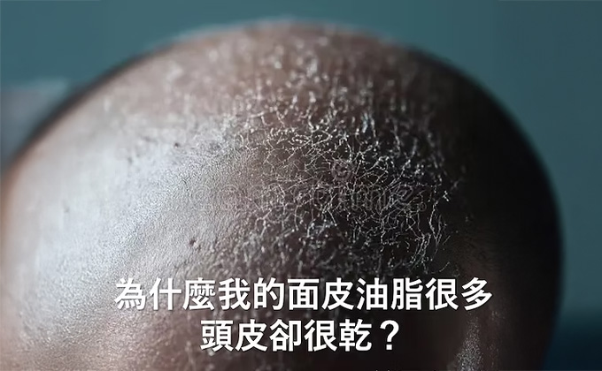 為什麼我的面皮油脂很多，頭皮卻很乾？