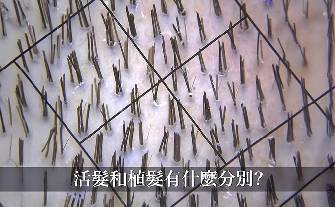 活髮和植髮有什麼分別？