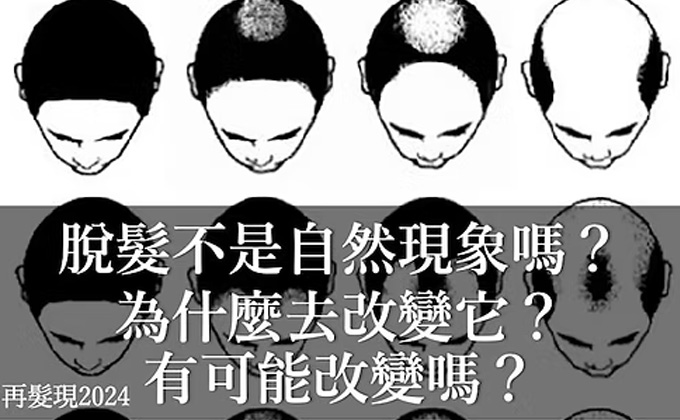 脫髮不是自然現象嗎？為什麼去改變它？有可能改變嗎？