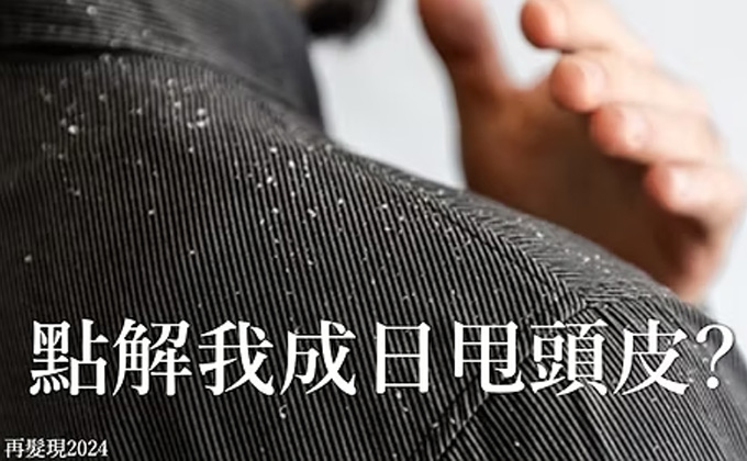點解我成日甩頭皮?